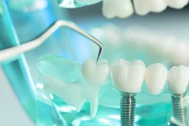 Diş diş dişçi modeli