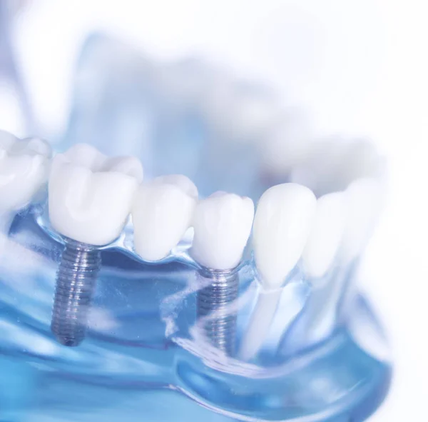 Οδοντιατρική Dentsts δοντιών εμφυτεύματος — Φωτογραφία Αρχείου