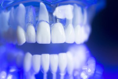 Diş hizalama diş modeli