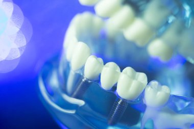 Diş hizalama diş modeli