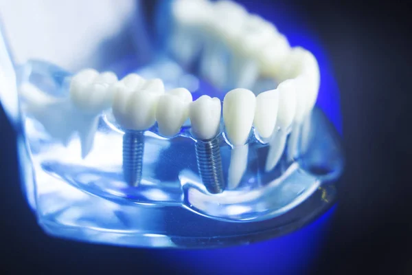 Dental teeth decay model — Stock Photo, Image