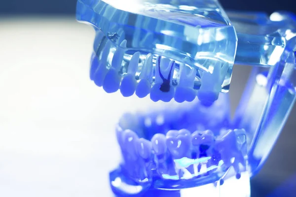 歯科歯臨床モデル — ストック写真