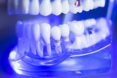 Diş hizalama diş modeli