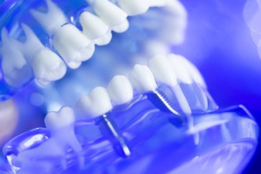 Diş hizalama diş modeli