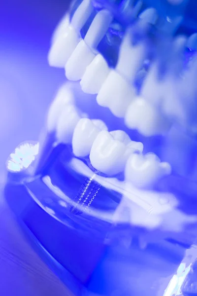 Modèle de dents d'alignement dentaire — Photo