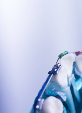 Diş diş köşeli metal