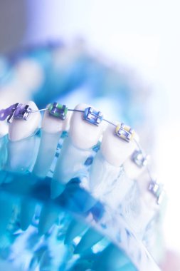 Diş diş köşeli metal