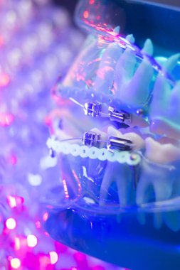 Diş diş köşeli metal