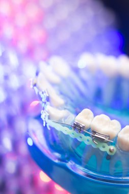 Diş diş köşeli metal