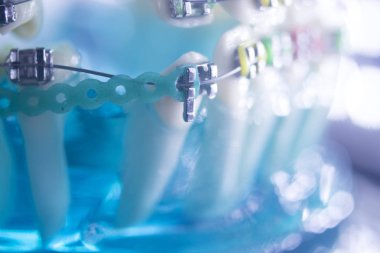 Diş diş köşeli metal