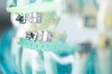 Diş diş köşeli metal