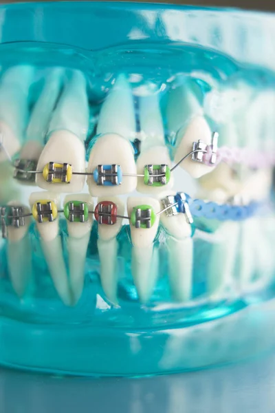 Dental teeth metal brackets — Stock Photo, Image