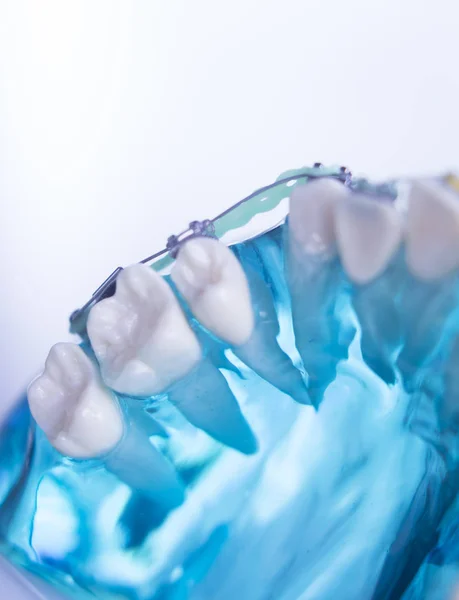 Zubní zuby kovové držáky — Stock fotografie