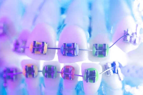 Zamki metalowe zębów dentystycznych — Zdjęcie stockowe