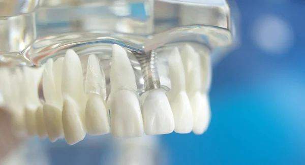 Zubní zuby v ústech model — Stock fotografie