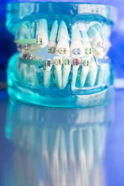 Diş diş köşeli metal