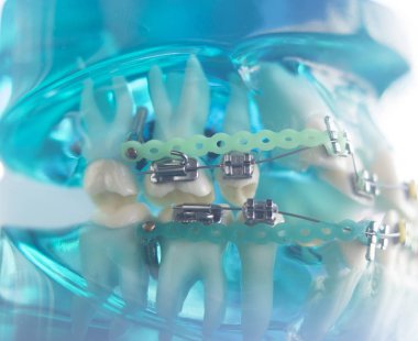 Diş diş köşeli metal