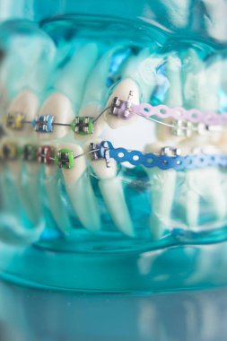 Diş diş köşeli metal