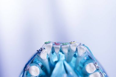 Diş diş köşeli metal