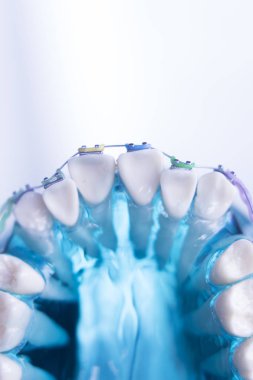 Diş diş köşeli metal