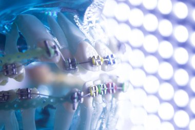 Diş diş köşeli metal