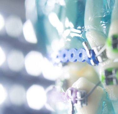 Diş diş köşeli metal