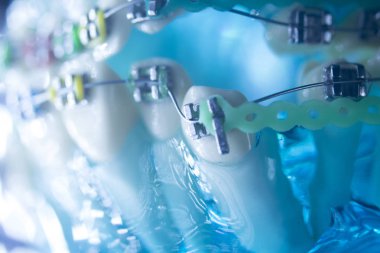 Diş diş köşeli metal