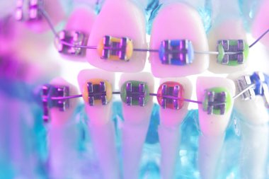 Diş diş köşeli metal