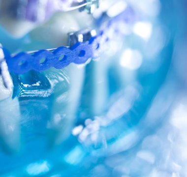 Diş diş köşeli metal