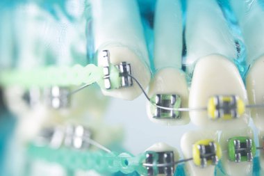 Diş diş köşeli metal