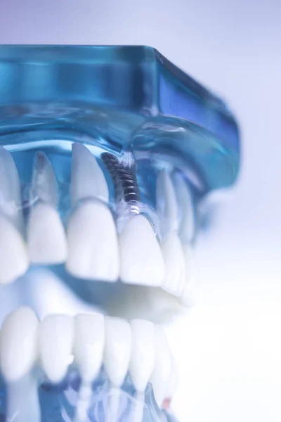 Стоматологічна імплантація зубів — стокове фото