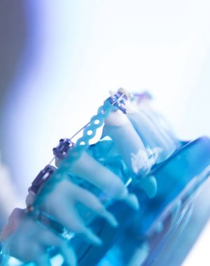 Diş diş köşeli metal