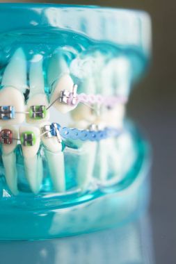 Diş diş köşeli metal