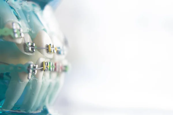 Οδοντιατρική δόντια μεταλλικά στηρίγματα — Φωτογραφία Αρχείου