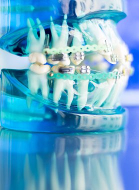 Diş diş köşeli metal