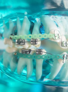 Diş diş köşeli metal