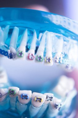 Diş diş köşeli metal