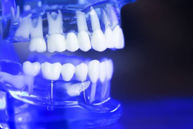 Diş diş klinik modeli