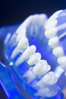 Diş hizalama diş modeli