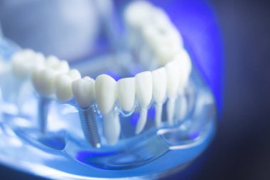 Diş diş çürümesi modeli