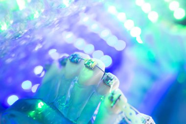 Diş diş köşeli metal