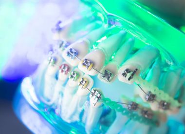 Diş diş köşeli metal