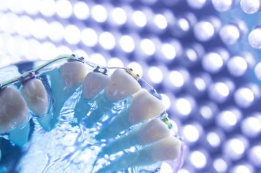 Diş diş köşeli metal