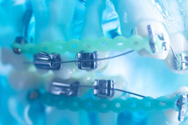 Diş diş köşeli metal