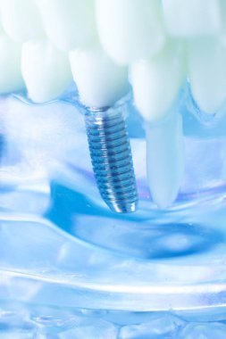 Diş titanyum implant diş