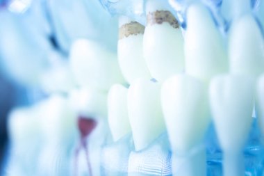 Dental plak diş çürüğü