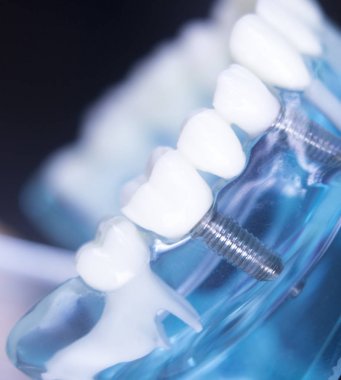 Dentsts diş implant diş