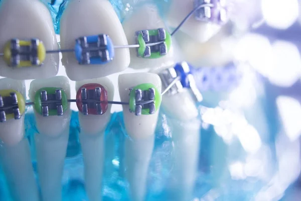 Dentes dentários suportes de metal — Fotografia de Stock