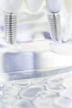 Diş titanyum implant diş