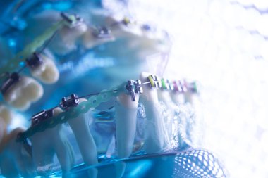 Diş diş köşeli metal